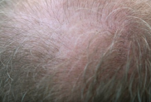 A scalp with thin, grey hair.