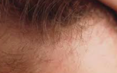 Do Women’s Hairlines Recede?