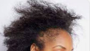 African American female with severe breakage on sides of head.