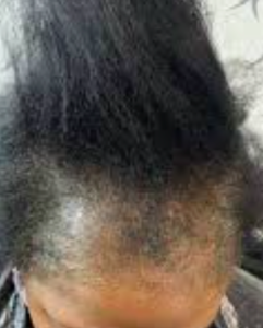 Woman with 4c hair with heavy breakage along the front hairline.
