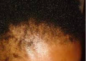 An African American female with a damaged hairline.