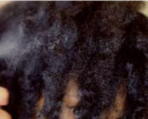 African textured hair matted in twists.