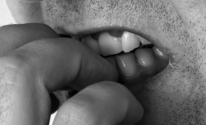 Close-up of a hand pulling back a lip to show teeth, in black and white