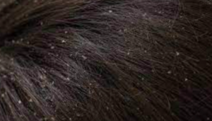 Reddish brown hair with lots of dandruff.