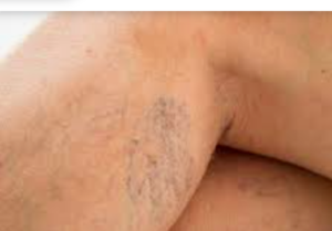 Varicose veins at the back of the knee and the calf.