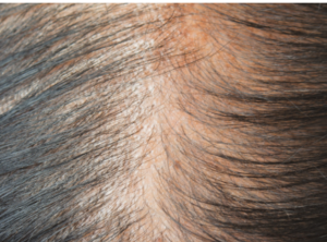 Thinning in the crown of a head of black hair.