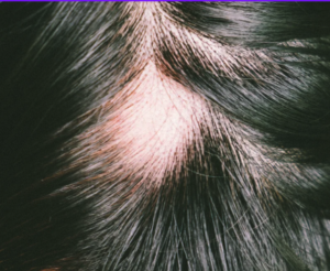 An alopecia spot in the crown of the head.