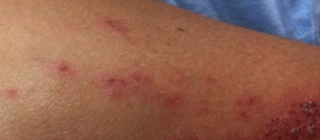 Allergic Reactions To Braiding Hair